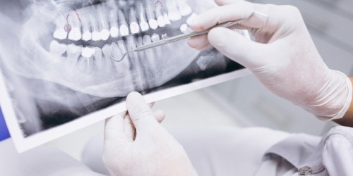 Can Root Canal Treatment Cause Cancer?